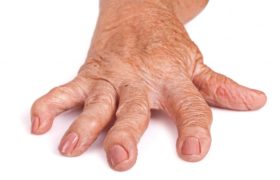 Ayurvedic treatment for arthritis