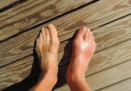 Ayurvedic treatment for arthritis