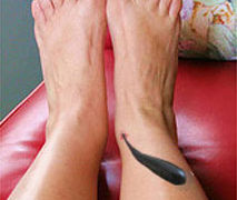 raktamokshana treatment