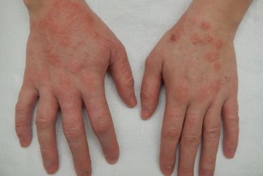 skin problems - Eczema Treatment