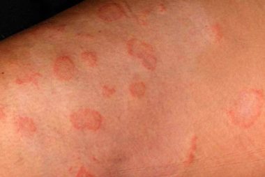 Ringworm Treatment