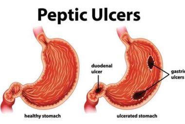 peptic ulcer treatment