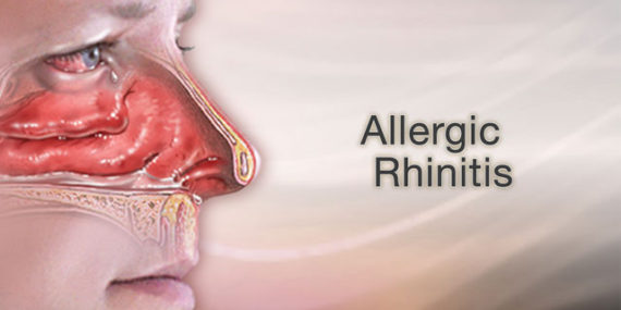 allergic rhinitis treatment