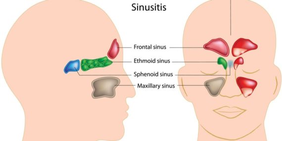 Sinusitis treatment