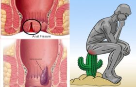 constipation treatment