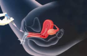 Uttarbasti treatment