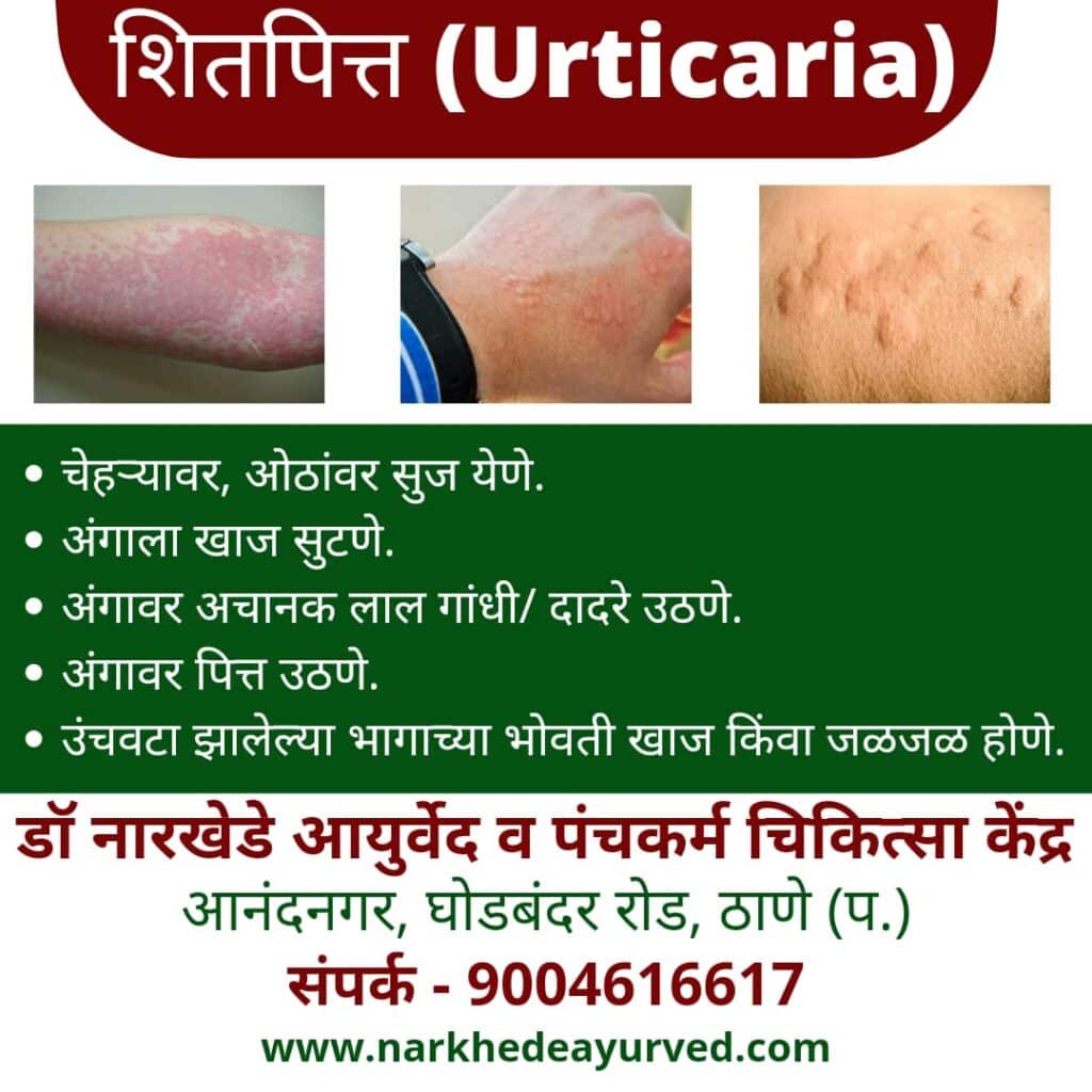 Ayurvedic treatment for urticaria