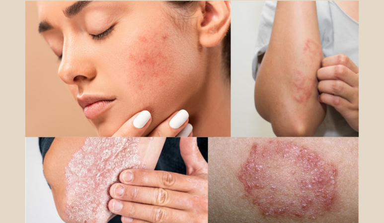Ayurvedic Treatment for Skin Problems